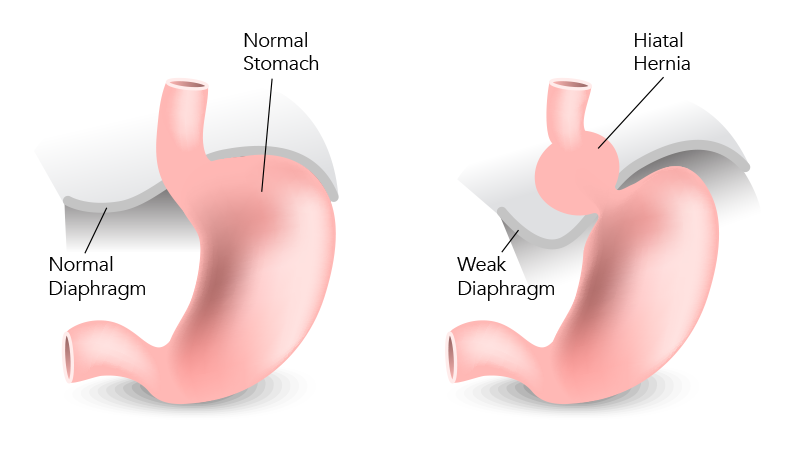 Understanding Hiatus Hernia