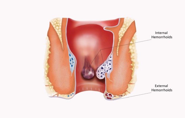 Understanding Hemorrhoids