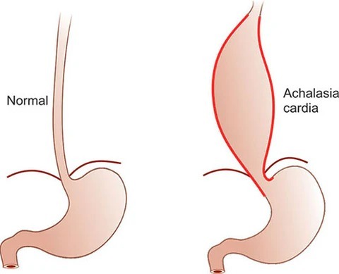 Understanding Achalasia