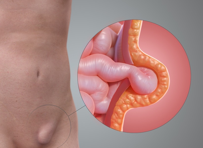 Understanding Hernia