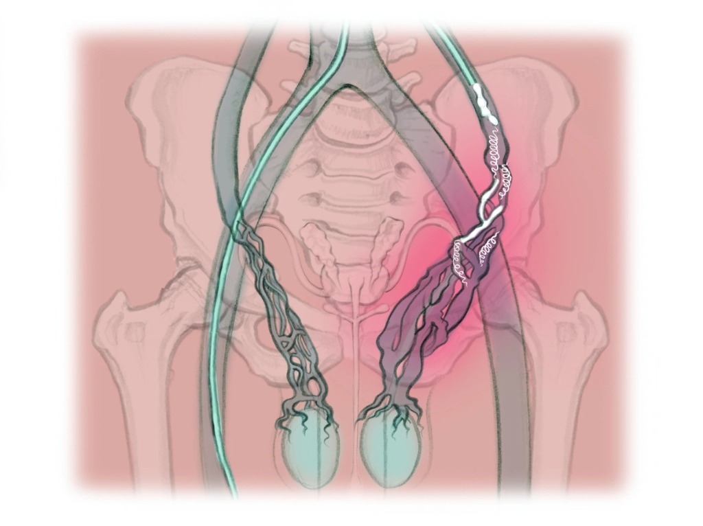 Understanding Varicocelectomy Surgery